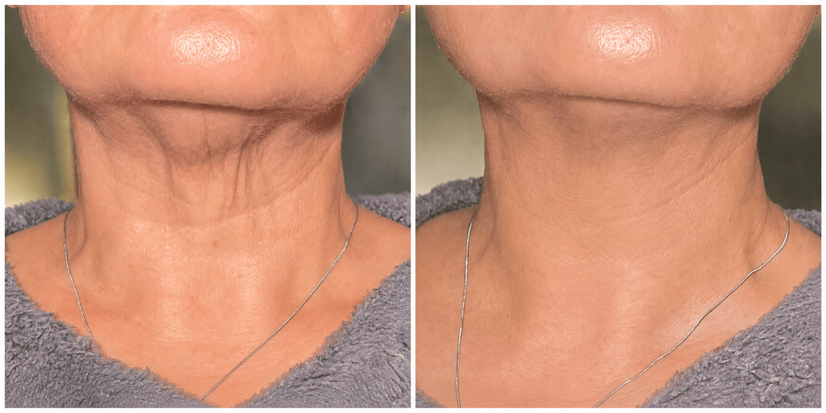 ACEITE PARA MASAJES ANTICELULITIS
