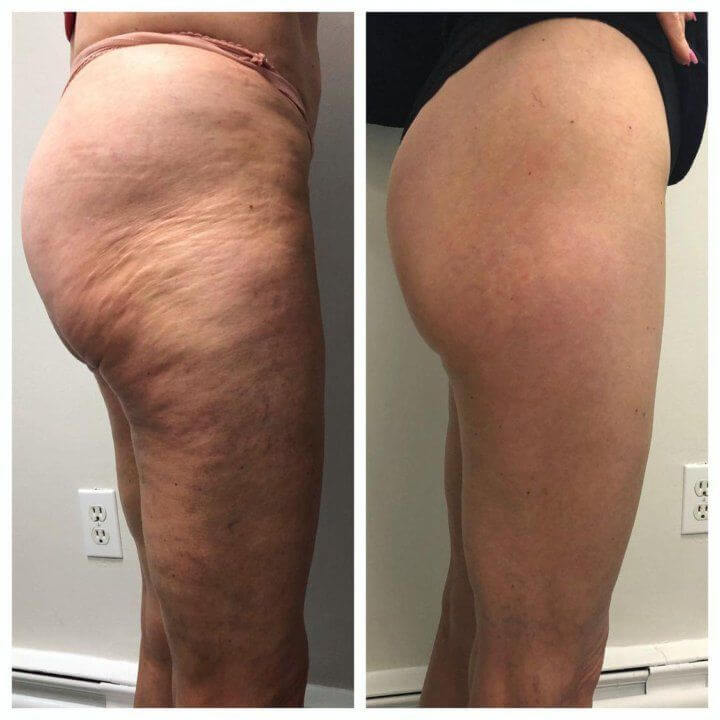 VITANATURALS TRATAMIENTO CORPORAL REAFIRMANTE